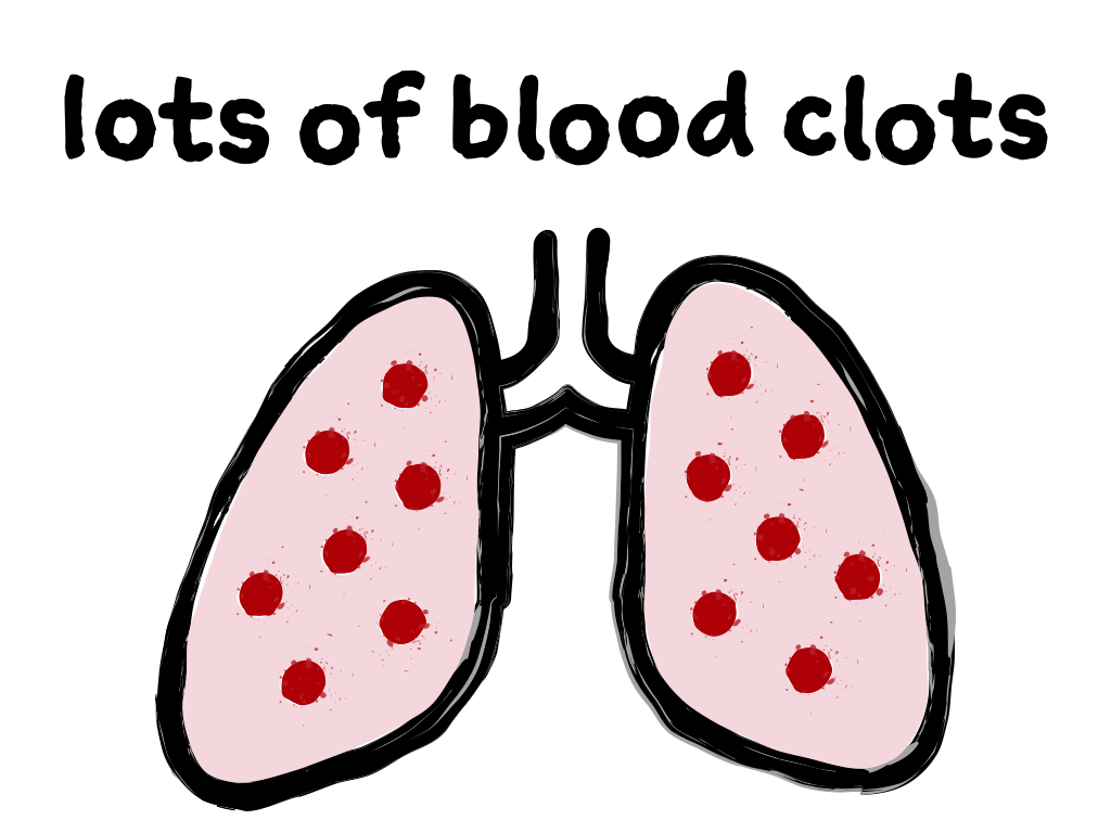 Slide content: text 'lots of blood clots' over a cartoon image of lungs with red spots.